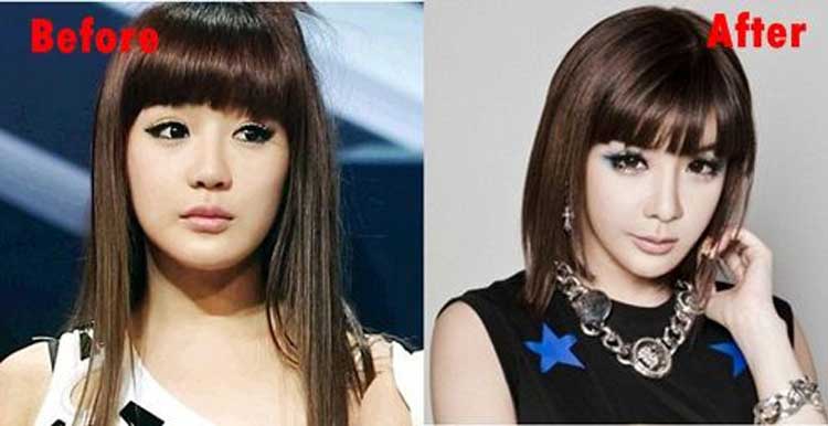 Park Bom Plastic Surgery: Eyelid Surgery, Nose Job, Chin Surgery