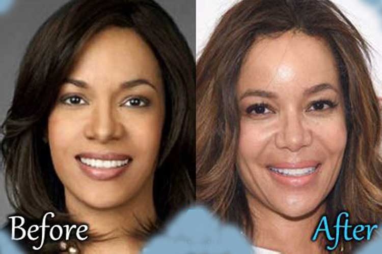 Sunny Hostin Plastic Surgery 