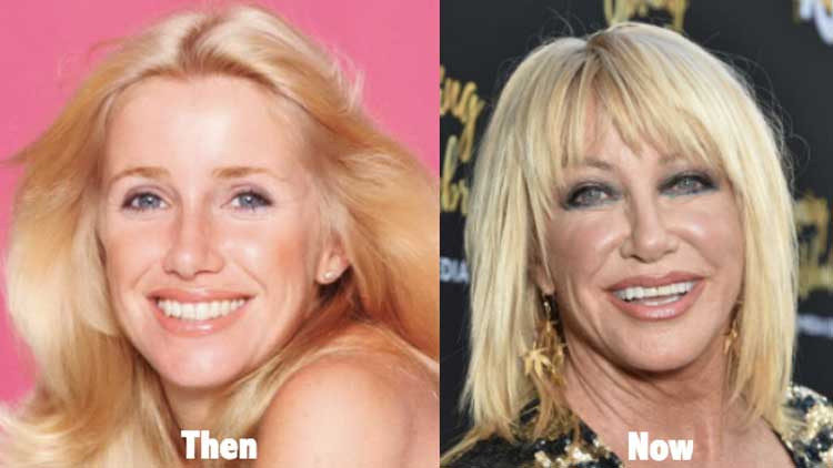 Suzanne Somers Plastic Surgery 