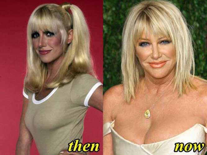 Suzanne Somers Plastic Surgery 