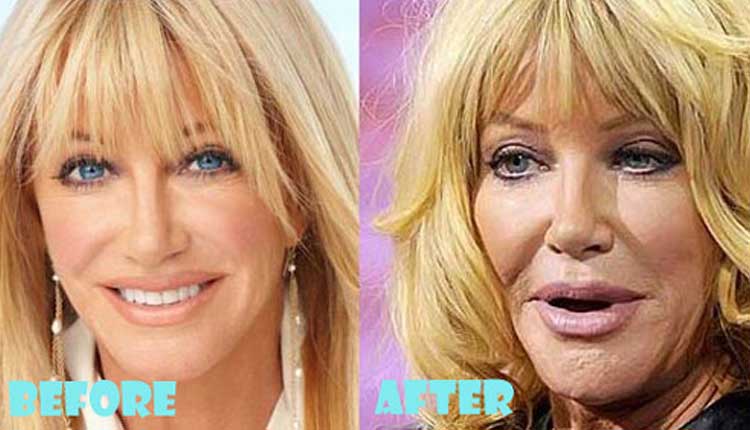 Suzanne Somers Plastic Surgery