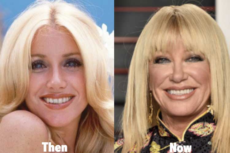 Suzanne Somers Plastic Surgery