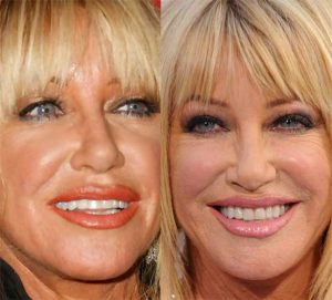 Suzanne Somers Plastic Surgery: boob job, lip fillers, eyelid surgery