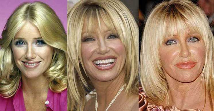 Suzanne Somers Plastic Surgery