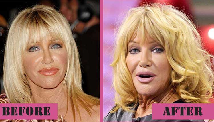 Suzanne Somers Plastic Surgery