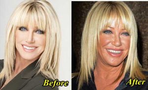 Suzanne Somers Plastic Surgery Boob Job Lip Fillers Eyelid Surgery