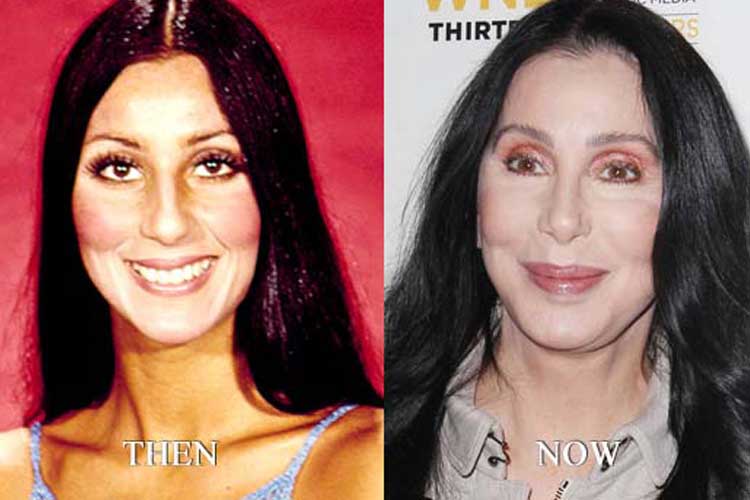 Cher Plastic Surgery: Breasts augmentation, Nose Job, Facelift