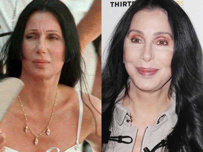 Cher plastic surgery