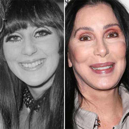 Cher Plastic Surgery: Breasts augmentation, Nose Job, Facelift