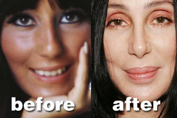 Cher Plastic Surgery: Breasts augmentation, Nose Job, Facelift