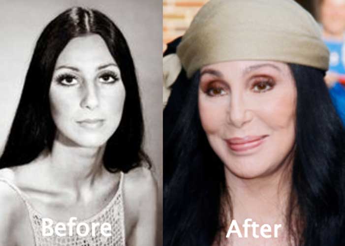 Cher Plastic Surgery: Breasts augmentation, Nose Job, Facelift