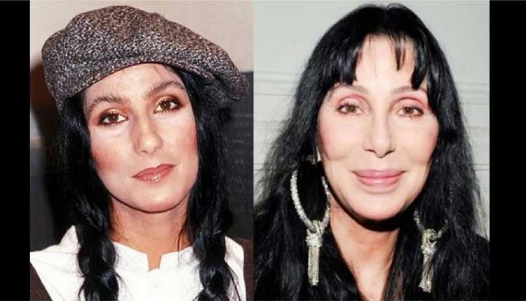 Cher plastic surgery