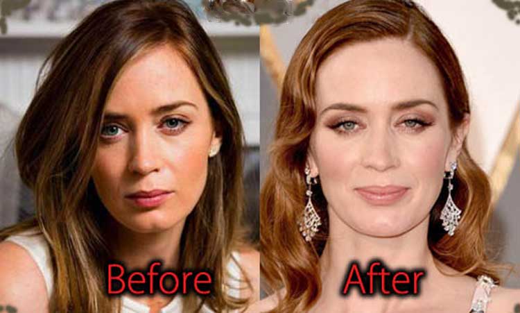 Emily Blunt plastic surgery.