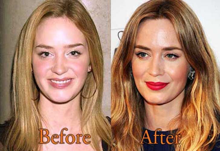 Emily Blunt plastic surgery 