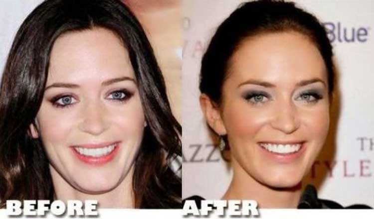 Emily Blunt Nose job.