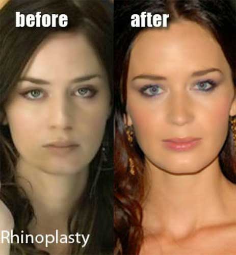 Emily Blunt plastic surgery 