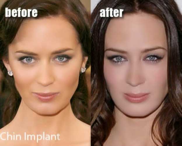 Emily Blunt plastic surgery 