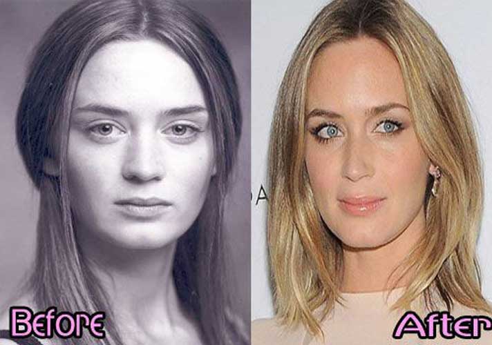 Emily Blunt plastic surgery 