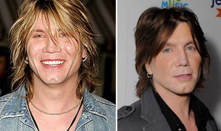 John Rzeznik plastic surgery