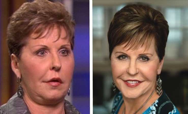 Joyce Meyer plastic surgery