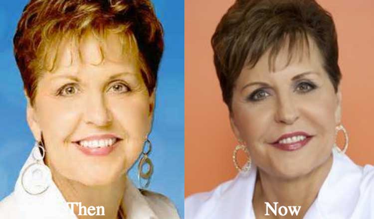 Joyce Meyer plastic surgery