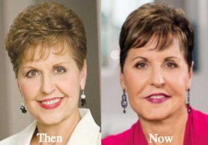 Joyce Meyer Plastic Surgery: Chin Improvement, Lip augmentation, Facelift