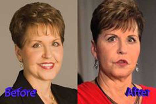 Joyce Meyer plastic surgery