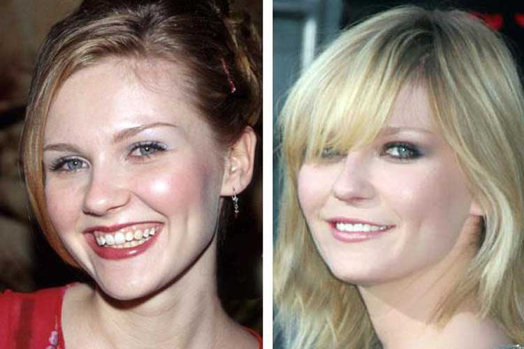 Kirsten Dunst Plastic Surgery Boob job, Teeth, Nose Job