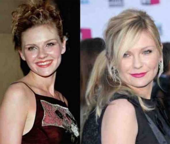 Kirsten Dunst Plastic Surgery Job. 