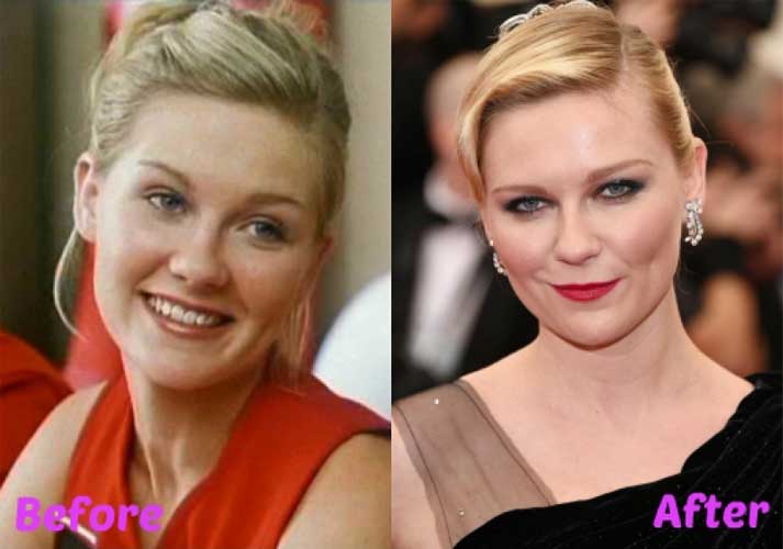 Kirsten Dunst Plastic Surgery 