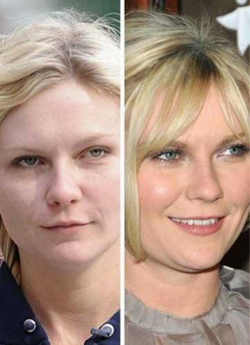 Kirsten Dunst Plastic Surgery 