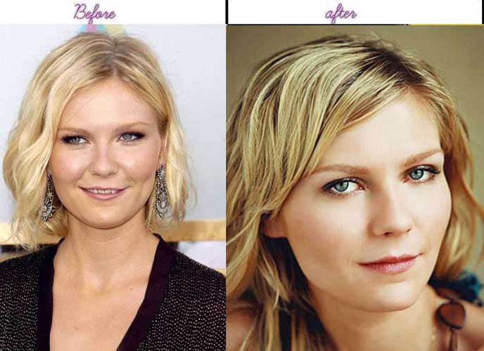 Kirsten Dunst Plastic Surgery 