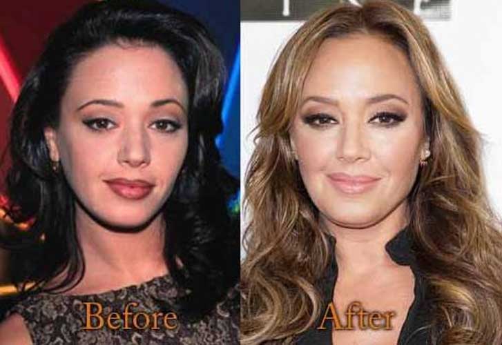 Leah Remini plastic surgery