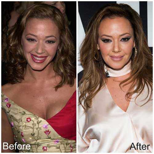 Leah Remini plastic surgery