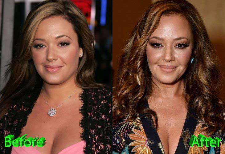 Leah Remini plastic surgery