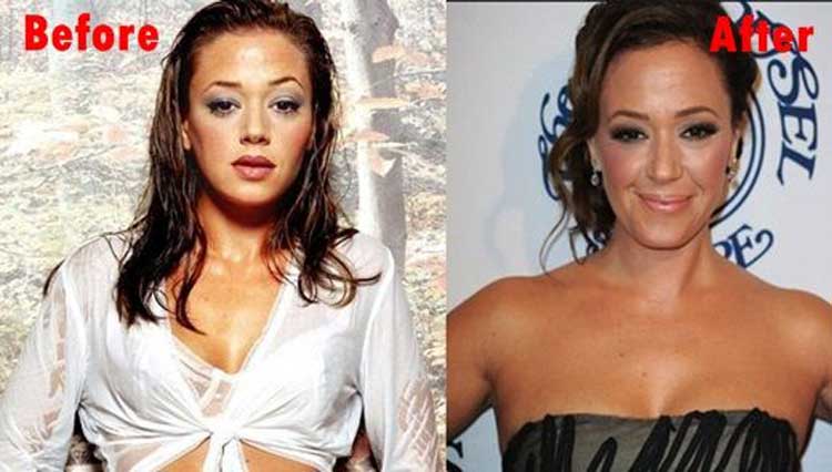 Leah Remini plastic surgery