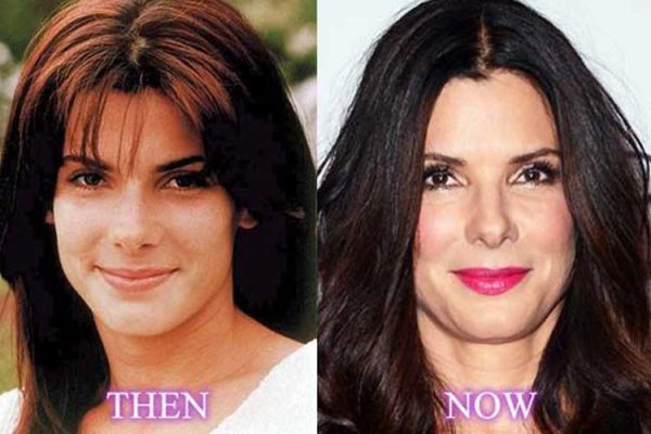 Sandra Bullock Plastic Surgery Cheek Filler Nose Job Facelift