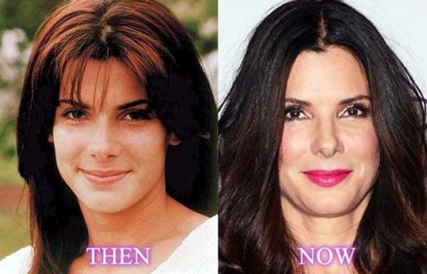 Sandra Bullock Plastic Surgery: Cheek Filler, Nose Job, Facelift