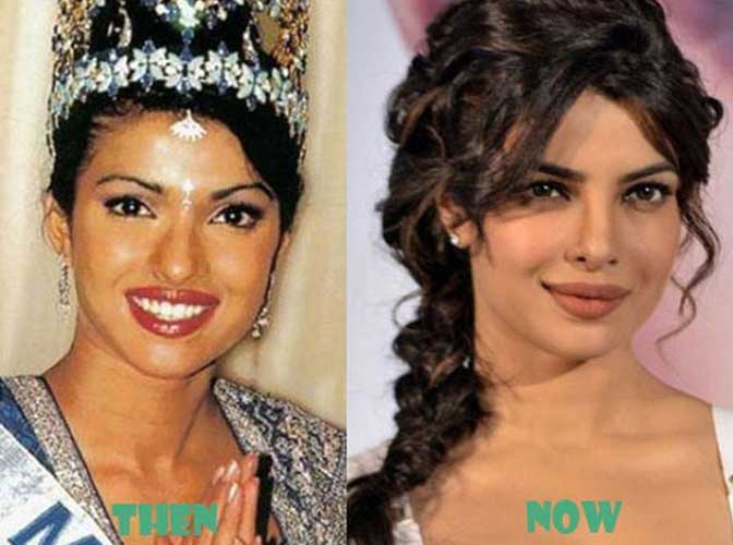 Priyanka Chopra plastic surgery 