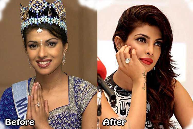 Priyanka Chopra plastic surgery 