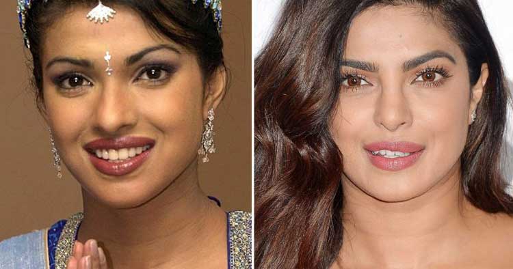 Priyanka Chopra plastic surgery