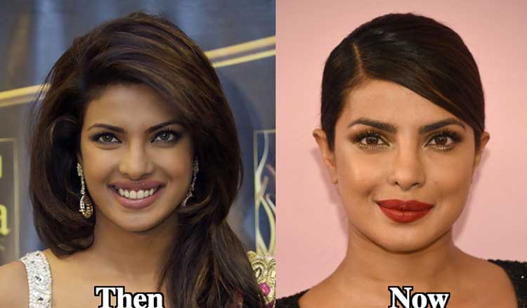 Priyanka Chopra plastic surgery 