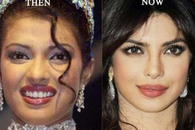 Priyanka Chopra plastic surgery 