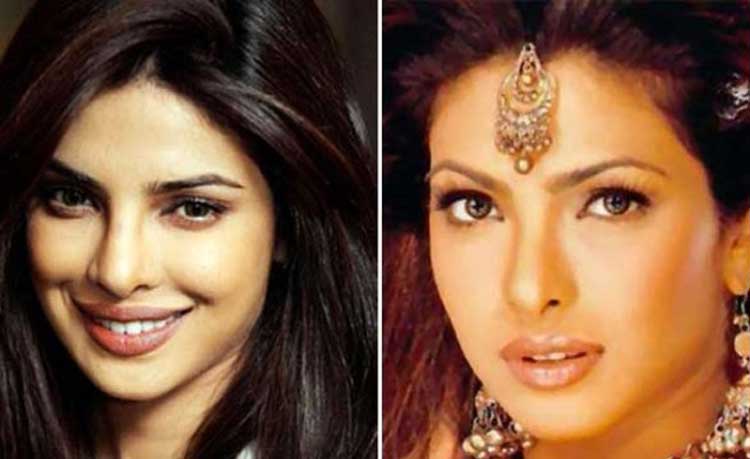 Priyanka Chopra plastic surgery 