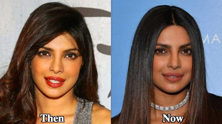 Priyanka Chopra plastic surgery