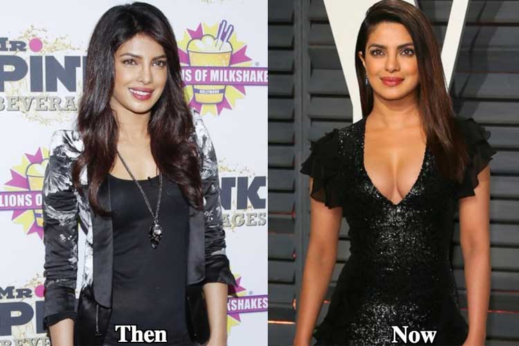 Priyanka Chopra plastic surgery