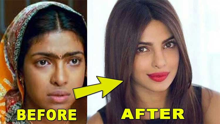 Priyanka Chopra plastic surgery 