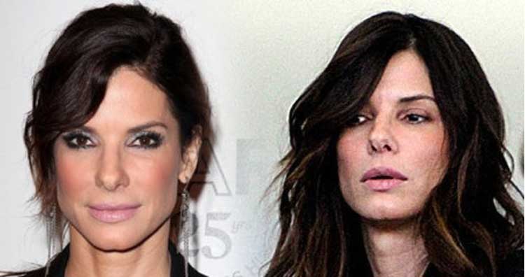 Sandra Bullock Cheek Filler