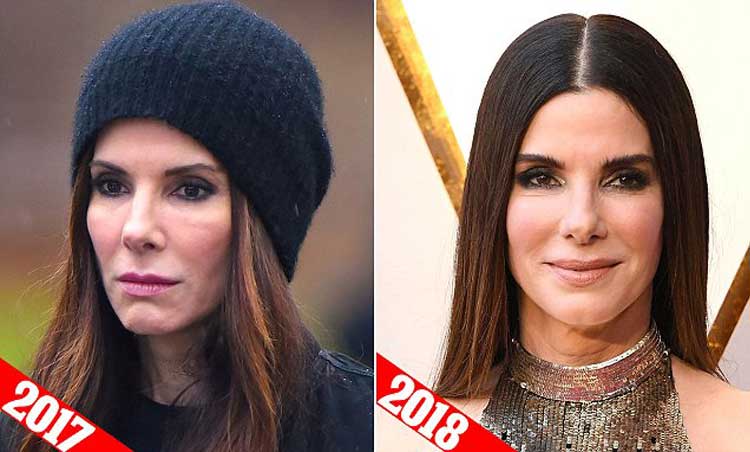 Sandra Bullock Cheek Filler