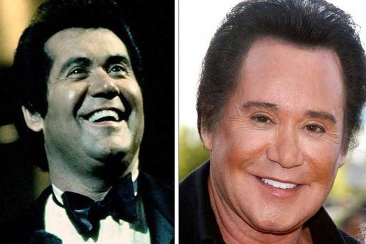 Wayne Newton Plastic Surgery: Facelift, Botox, Eyelid Surgery